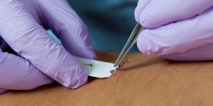 Image of sutures being removed using forceps and SutureOut tool.